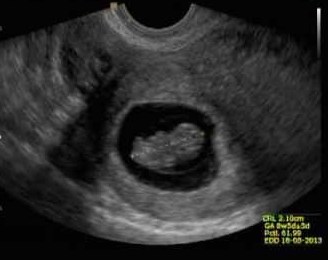 Dentro do saco gestacional (parte preta) há um feto de 8 semanas